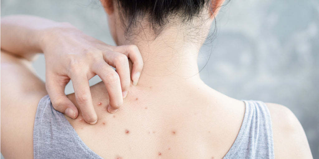 How to Get Rid of Back Acne?