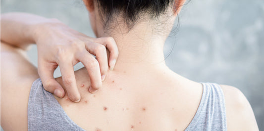 How to Get Rid of Back Acne？